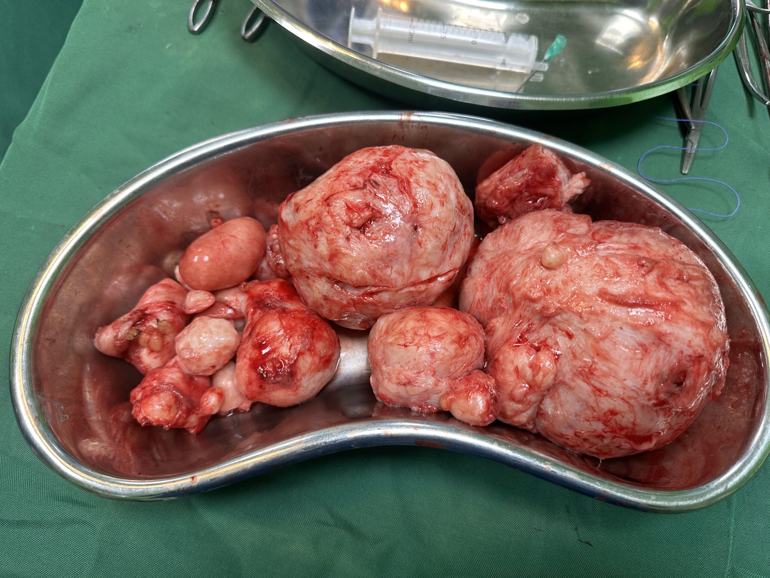 The Fibroid Fight: The Hidden Burden Many Women Carry.